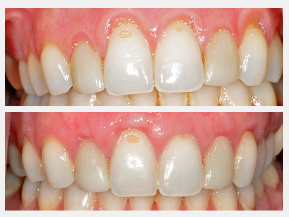 soft tissue grafting