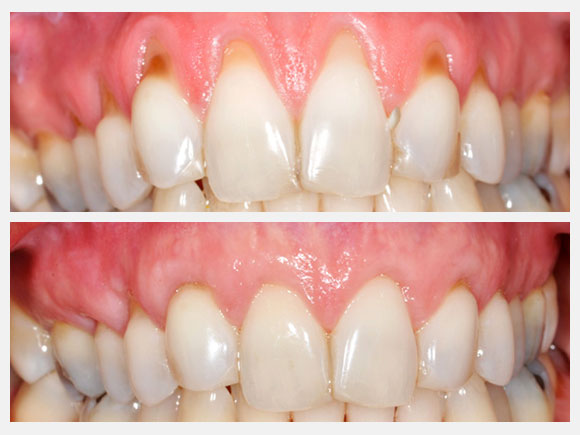 soft tissue grafting