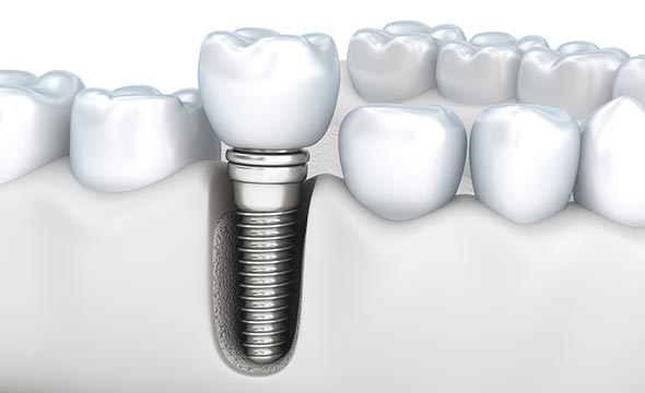 dental implant