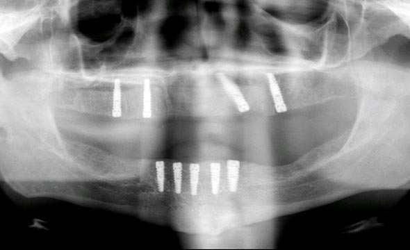 x ray image of dental implants
