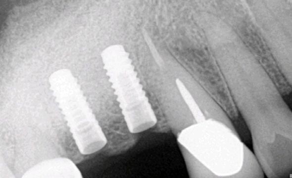 x ray image of two dental implants