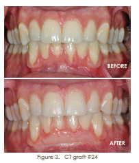 gingival recession tissue graft