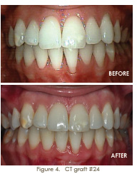 gingival recession tissue graft