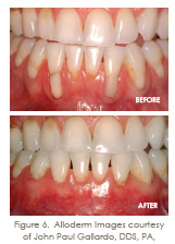 soft tissue graft alloderm