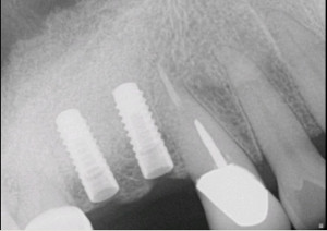 dental implants x ray