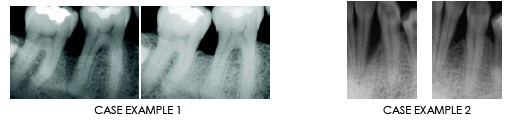 guided bone regeneration