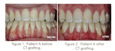 before and after soft tissue grafting
